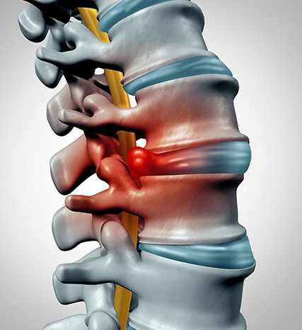 nerve  compression